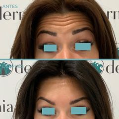 Rellenos faciales - Dermia