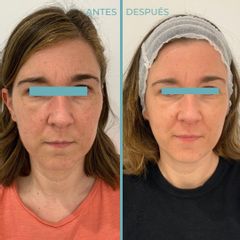 Rellenos faciales - Dermia