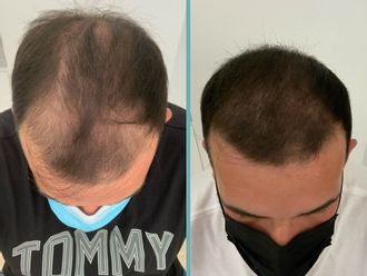 Alopecia antes y después - 861028