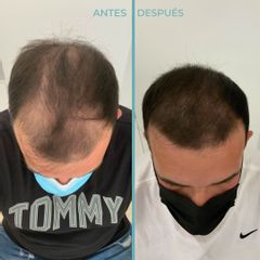 Alopecia - Dermia