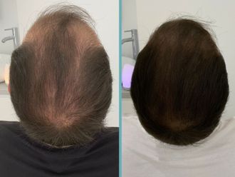 Alopecia antes y después - 861029