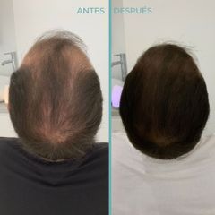 Alopecia - Dermia