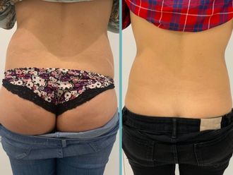 Mesoterapia antes y después - 861030