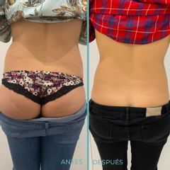 Mesoterapia - Dermia