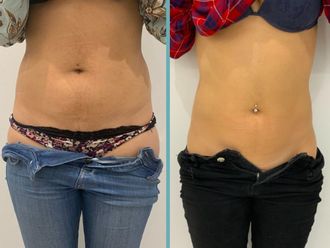Mesoterapia antes y después - 861031