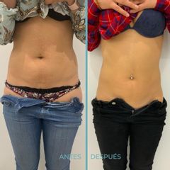Mesoterapia - Dermia
