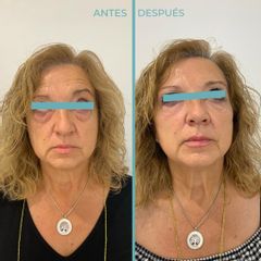 Eliminación de ojeras - Dermia