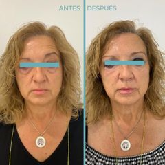 Eliminación de ojeras - Dermia