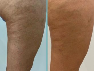 Láser vascular antes y después - 861034