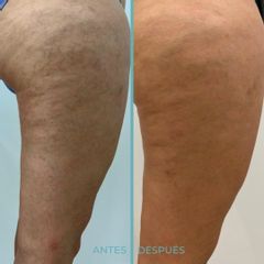Láser vascular - Dermia