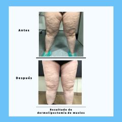Dermolipectomía - Dra. Dolça López Munne