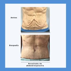 Abdominoplastia - Dra. Dolça López Munne