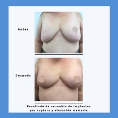 Mastopexia - Dra. Dolça López Munne