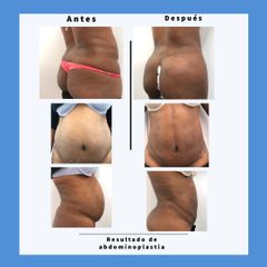 Abdominoplastia - Dra. Dolça López Munne