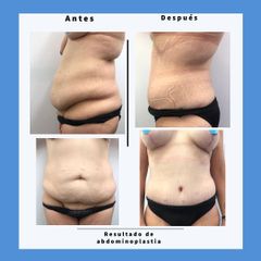 Abdominoplastia - Dra. Dolça López Munne