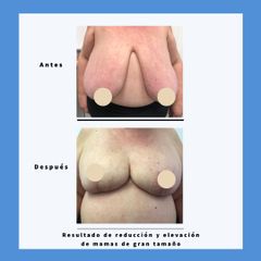 Reducción senos - Dra. Dolça López Munne