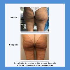 Liposucción - Dra. Dolça López Munne