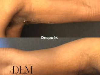 Lifting antes y después - 874514