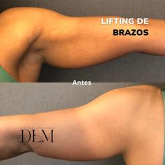 Dos meses después de la cirugía de retirada de piel en los brazos