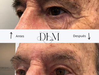Blefaroplastia antes y después - 874516