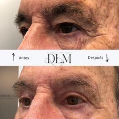 Antes y 4 meses después de una blefaroplastia superior