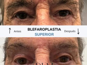 Blefaroplastia antes y después - 874517