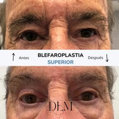 Antes y 4 meses después de una blefaroplastia superior