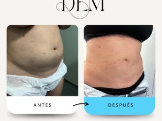 Liposucción antes y después - 874518