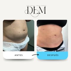 Tres meses después de una liposucción abdominal