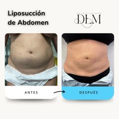 Tres meses después de una liposucción abdominal