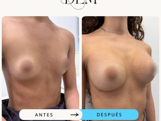 Aumento de pecho antes y después - 874520