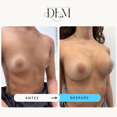 Antes y después de un aumento mamario con implantes de 260 cc