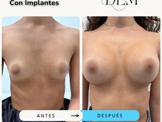 Aumento de pecho antes y después - 874521
