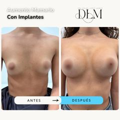 Antes y después de un aumento mamario con implantes de 260 cc