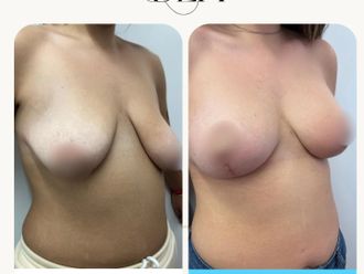 Mastopexia antes y después - 874522