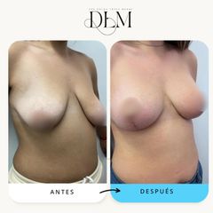 Antes y 2 meses después de una elevación mamaria con implantes