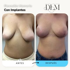 Antes y 2 meses después de una elevación mamaria con implantes