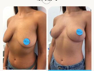 Mastopexia antes y después - 874525