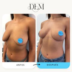 Antes y 3 meses después de una elevación mamaria sin implantes