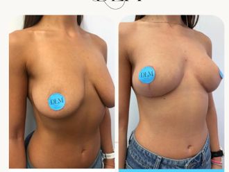 Mastopexia antes y después - 874526