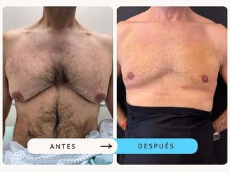 Ginecomastia antes y después - 875378