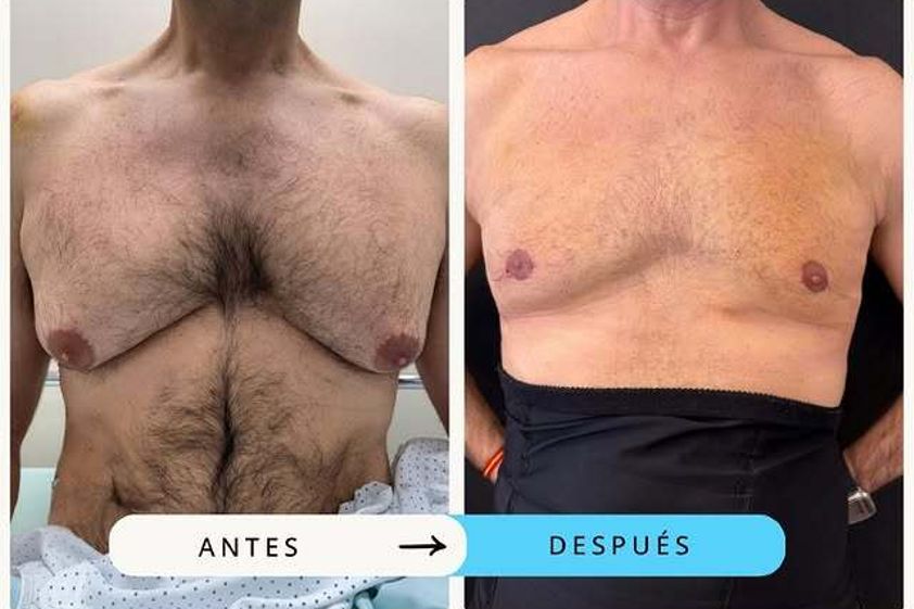Ginecomastia antes y después - 875378