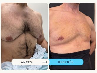 Ginecomastia antes y después - 875379