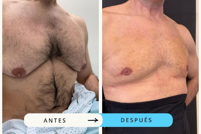 Ginecomastia antes y después - 875379
