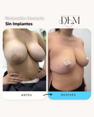Mastopexia