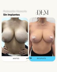 Mastopexia