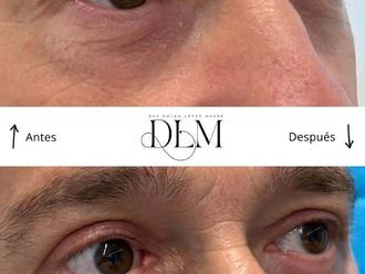 Blefaroplastia antes y después - 875382
