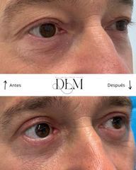 Blefaroplastia