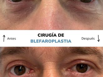 Blefaroplastia antes y después - 875383