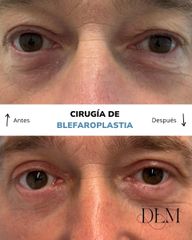 Blefaroplastia
